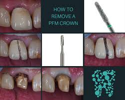 How To Remove A Crown Dental Head Start