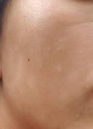 Pityriasis alba (pa) is an eczematous dermatosis characterized by patchy hypopigmentation. Skin Concerns How To Cure My Skin From Pityriasis Alba Skincareaddiction