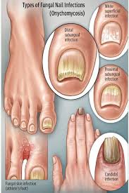 fungal toenails foot ankle