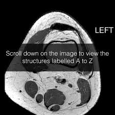 Involved early gray = muscle: Anatomy Quiz Mri Knee Radiology Case Radiopaedia Org