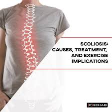 scoliosis causes treatment and
