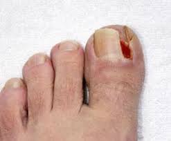 ingrown toenails treatment foot