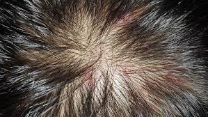 common scalp conditions pictures