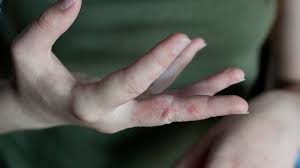 hand fungus and eczema