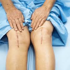 recovery timeline for knee replacement