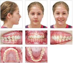 Exceeding that limit will damage the teeth permanently. Scielo Brasil Different Approaches To The Treatment Of Skeletal Class Ii Malocclusion During Growth Bionator Versus Extraoral Appliance Different Approaches To The Treatment Of Skeletal Class Ii Malocclusion During Growth