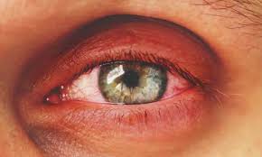 blepharitis treatments surevision eye