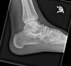 1 department of radiology and inje university busan paik hospital, inje university college of haglund syndrome was first described in 1928 as retrocalcaneal bursitis associated with an. A 31 Y O Male Comes In With Bilateral Heel Pain His Xray Is Shown Below Everyday E B M