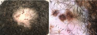 scarring alopecias springerlink