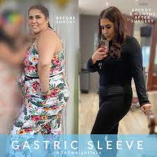 before and after gastric sleeve photos