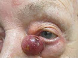merkel cell carcinoma of the eyelid