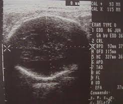2nd And 3rd Trimester Ultrasound Scanning