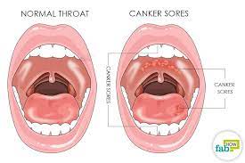 It mostly occurs on the lips, in mouth, on tongue and throat. How To Get Rid Of Canker Sores Fab How