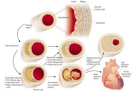 Pathogenesis Of Atherosclerosis
