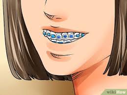 Squeeze until it softens and roll it into a ball, then flatten the ball slightly. How To Apply Dental Wax On Braces 12 Steps With Pictures