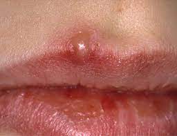 20 types of skin lesions causes and