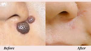 If you aren't sure which type of skin cancer. Mole Removal Scar Chances Care And Pictures