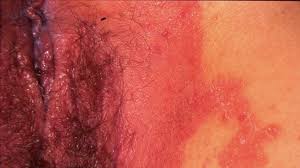 Does jock itch occur in both males and females? Inverse Psoriasis Or Jock Itch Which Is It