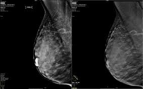 Time Magazine Highlights Digital Breast Tomosynthesis As One Of The