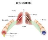 نتیجه جستجوی لغت [bronchitis] در گوگل