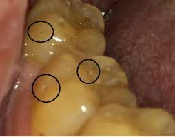 A small cavity typically will feel normal. Dentist A 3 Small Cavities Need To Be Filled Dentist B No Fillings Needed I Have No Idea What To Do Dentistry