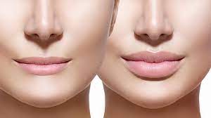 lip lifts vs lip fillers what s the