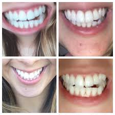 It can be difficult to determine whether you have a cavity. Periodontal Disease Cure Reddit
