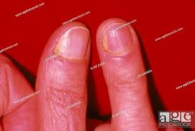 mycosis br fungal nail infection caused