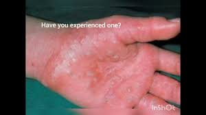 what is dyshidrotic eczema you