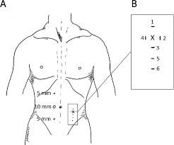 placement of transabdominal sches