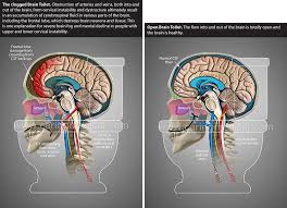 internal jugular vein stenosis