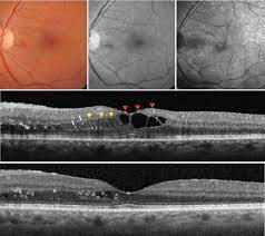 macular edema following cataract