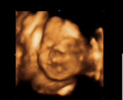 possible cleft lip 3d ultrasound