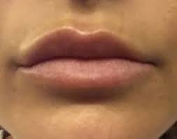 uneven lips one week after lip fillers