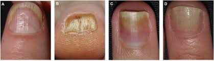 translated article nail psoriasis