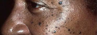 warts advanced skin clinic uganda