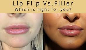 lip flip or lip filler which is