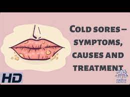 cold sores symptoms causes and