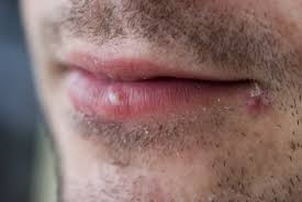 garlic to wipe out cold sores