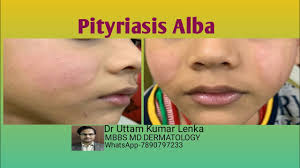 The name describes its appearance: What Is Pityriasis Alba Treatment Prevention White Spots On Cheek Of Children Youtube