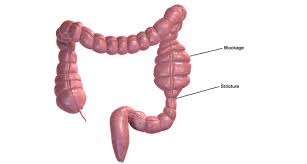 ileocaecal resection for crohn s
