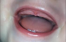 Явление часто сопровождается гормональными сбоями теперь вы знаете, что такое гингивит у детей, его причины, как лечить недуг при прорезывании зубов у малышей, а также какие меры стоит. Sinyaya Desna Pri Prorezyvanii Zubov U Rebenka Pochemu Poyavilas Chernaya Ili Fioletovaya Gematoma