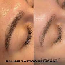 saline tattoo removal one of the best
