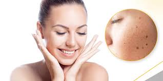 Face Skin Pigmentation Treatment Mumbai, Hyperpigmentation Cost India - The  Esthetic Clinics