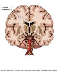 Check spelling or type a new query. Periventricular Leukomalacia Pvl Brain Damage In Newborns