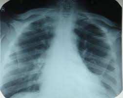 What is apico lordotic means. Apical Lordotic View In Chest X Ray Pg Blazer