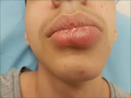 borrelial lymphocytoma of the lip the