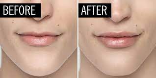 8 common myths about lip injections and