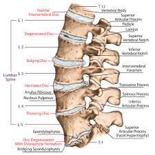 how long for herniated disc back pain