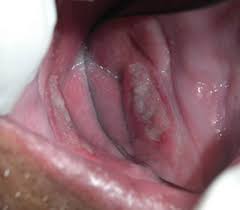 ulcer an uncommon site in primary